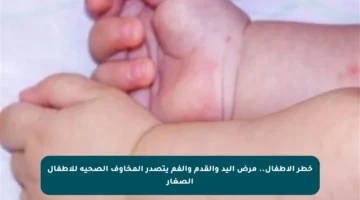 خطر الأطفال.. مرض اليد والقدم والفم يتصدر المخاوف الصحية للأطفال الصغار